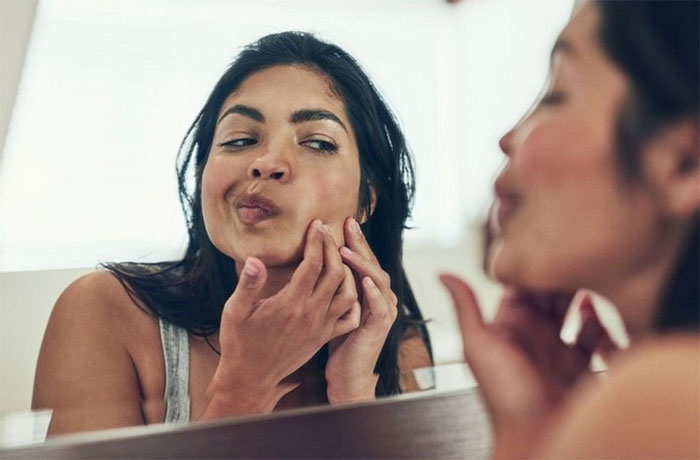 Picture 2 of Scientists are still arguing over what the actual cause of acne is
