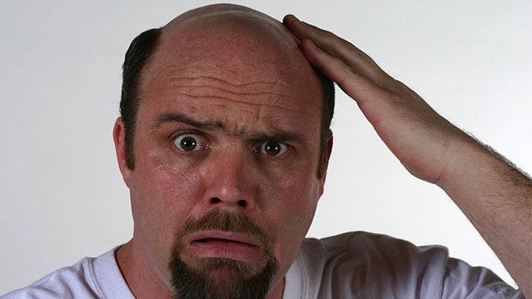 Picture 2 of Scientists unknowingly found a way to break the baldness