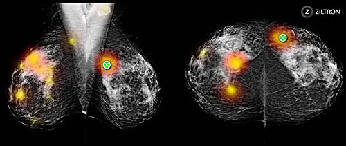 Picture 2 of Screening program for early detection of breast cancer