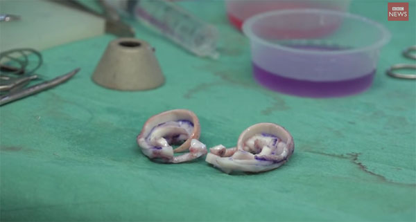 Picture 1 of See artificial ear from human ribs