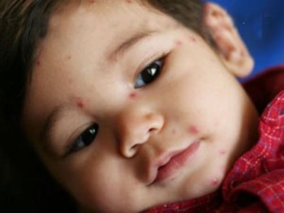 Picture 1 of Signs and ways to take care of chickenpox patients
