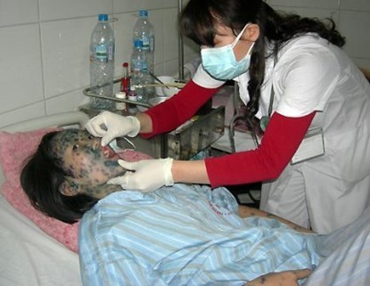 Picture 2 of Signs and ways to take care of chickenpox patients