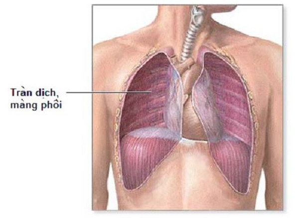 Picture 2 of Signs of pleural effusion and treatment