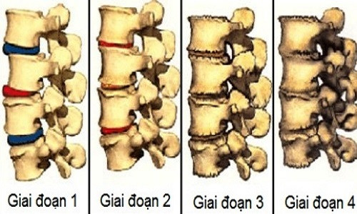 Picture 1 of Signs of spinal degeneration
