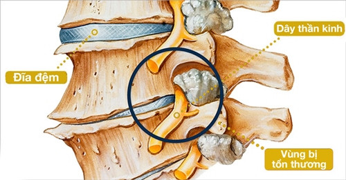 Picture 2 of Signs of spinal degeneration