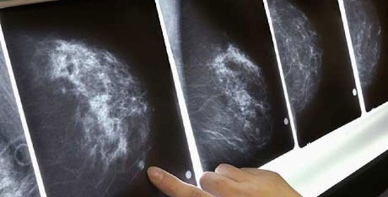 Picture 1 of Similarities between breast and ovarian cancer