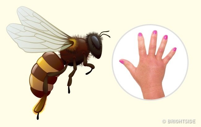 Picture 1 of Simple way to 'identify' an insect bite