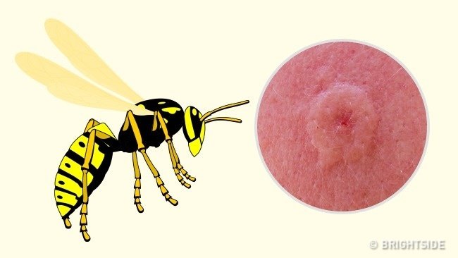 Picture 3 of Simple way to 'identify' an insect bite
