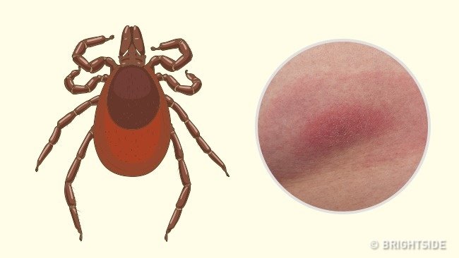 Picture 5 of Simple way to 'identify' an insect bite
