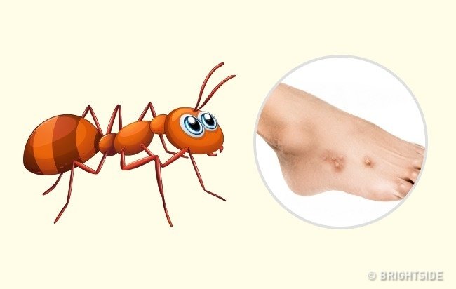 Picture 7 of Simple way to 'identify' an insect bite