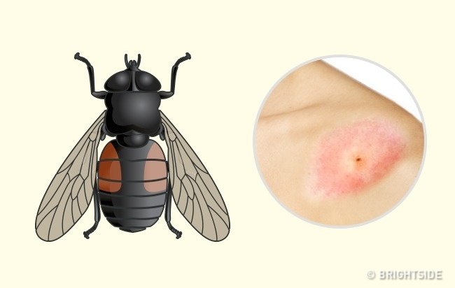 Picture 8 of Simple way to 'identify' an insect bite