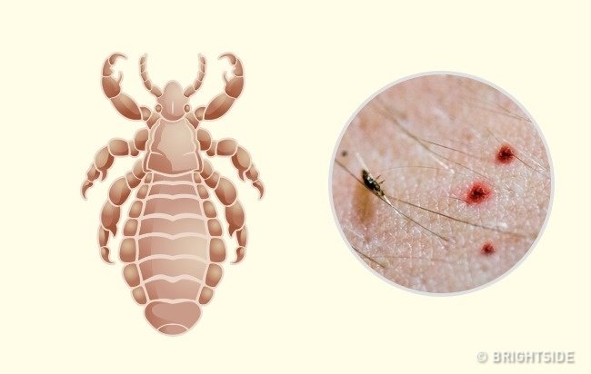 Picture 9 of Simple way to 'identify' an insect bite