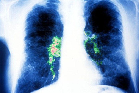 Picture 3 of Sitting in the air for a certain amount of care must be careful of this disease