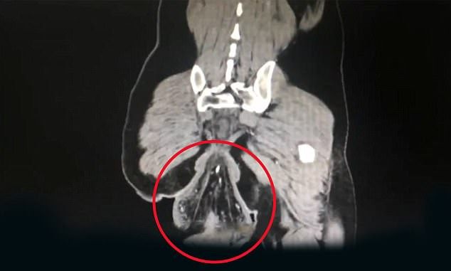 Picture 1 of Sitting in the toilet for too long, the man's organs fell out