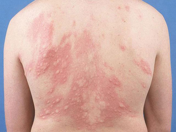 Picture 2 of Skin diseases in the cold season are easy to relapse