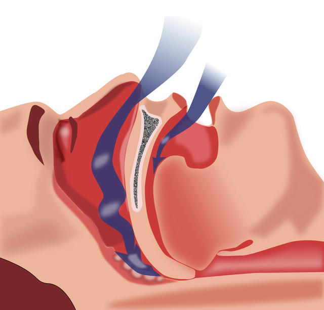 Picture 3 of Sleep apnea - a danger sign