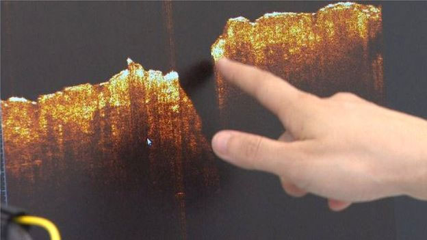 Picture 5 of Smart sensor knows 'hearing' healing wounds