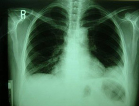Picture 1 of Smoking can reduce life expectancy by 15 years
