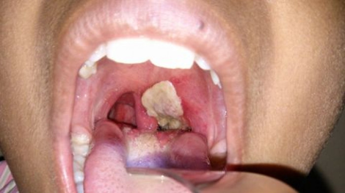 Picture 1 of Sore throat: Very dangerous manifestations of diphtheria are outbreaks