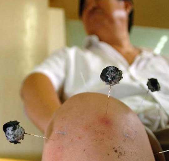 Picture 2 of Special acupuncture procedures of Chinese people
