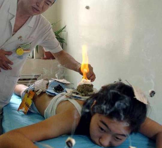 Picture 3 of Special acupuncture procedures of Chinese people