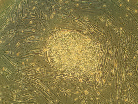 Picture 2 of Stem cell transplant to cure blindness
