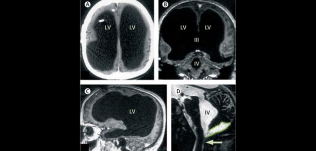 Picture 2 of Still living well despite missing half a brain