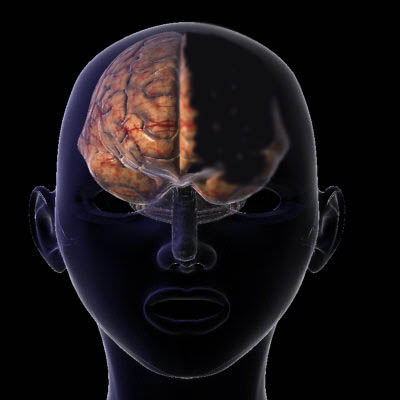 Picture 3 of Still living well despite missing half a brain