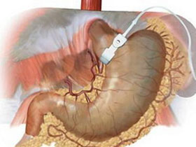 Picture 1 of Stomach tightening - an effective solution for obese people