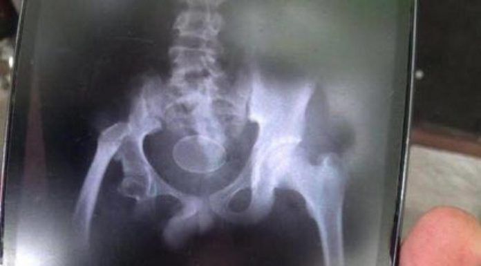 Picture 2 of Strange 12-year-old boy a week ... laid out 7 eggs?