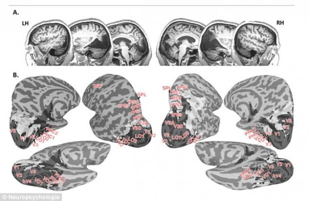 Picture 2 of Strange disease makes blind women see only moving objects