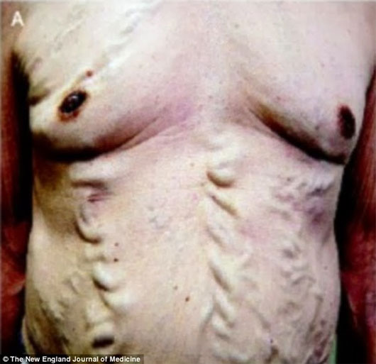 Picture 1 of Strange disease: The blood vessels float like a snake under the skin