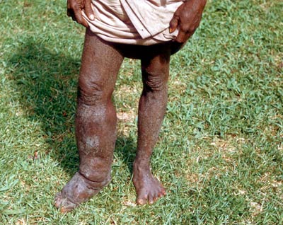 Picture 7 of Strange diseases