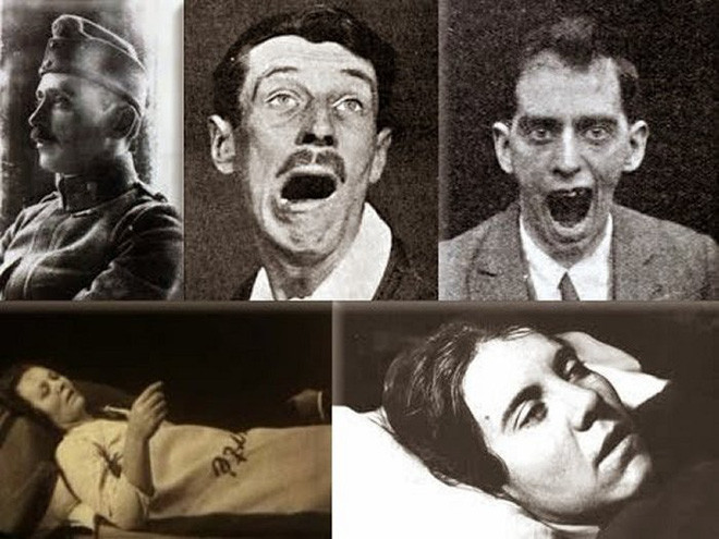 Picture 3 of Strange sleeping sickness once spread the nightmare in the world