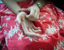 Picture 1 of Stress can cause itching