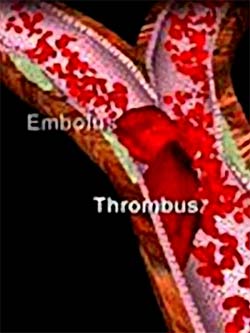 Picture 2 of Stroke, second disease after a traumatic brain injury