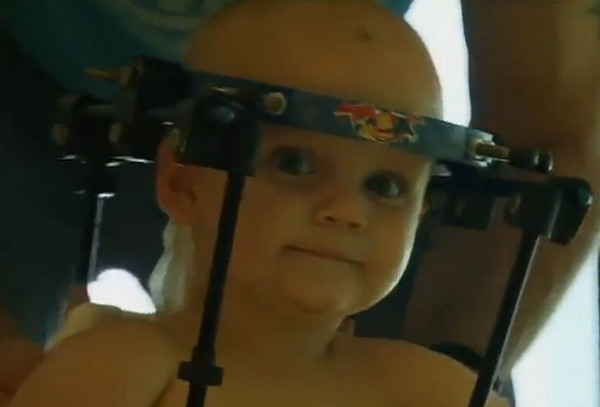Picture 1 of Successful head transplant surgery for one-year-old boys