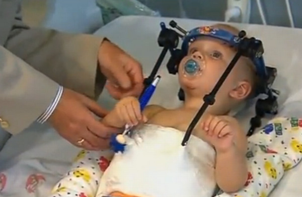 Picture 2 of Successful head transplant surgery for one-year-old boys