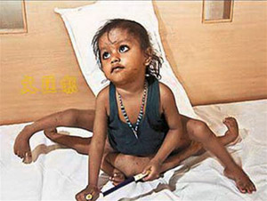 Picture 2 of Successful surgery in India for 8 girls