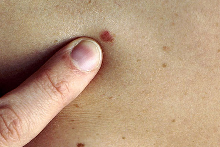 Picture 1 of Successfully developed the system for early detection of skin cancer