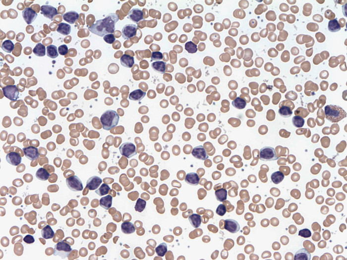 Picture 2 of Successfully modulate drugs that can cure blood cancer