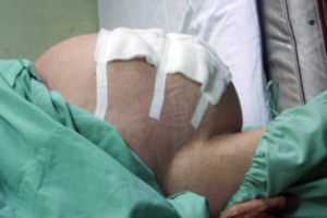Picture 1 of Successfully peeling tumors of 12 kg in the abdomen