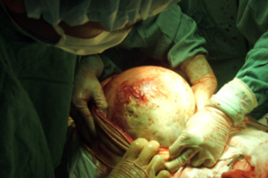 Picture 2 of Successfully peeling tumors of 12 kg in the abdomen