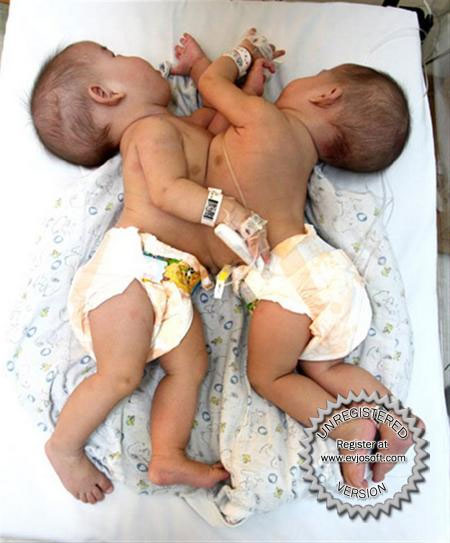 Picture 1 of Successfully separated conjoined twins