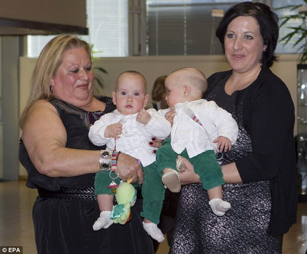 Successfully separated conjoined twins images 2