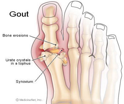 Picture 1 of Sugar Fructose and gout, fatty liver disease