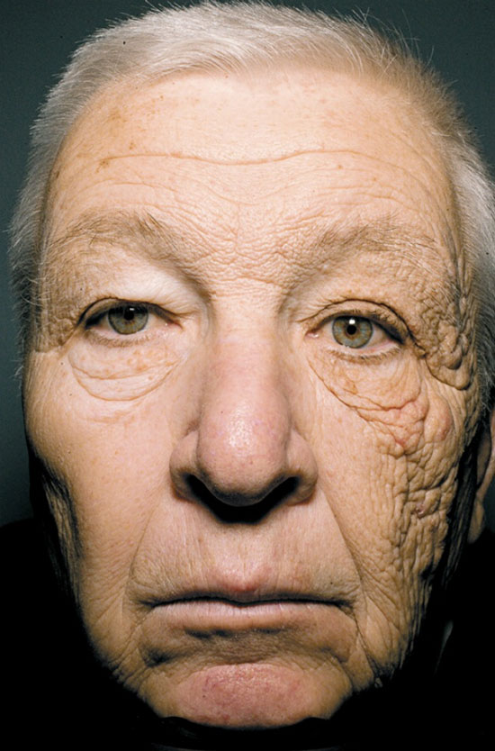 Picture 1 of Sun damage ability