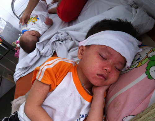 Picture 1 of Symptoms and how to care for children with measles
