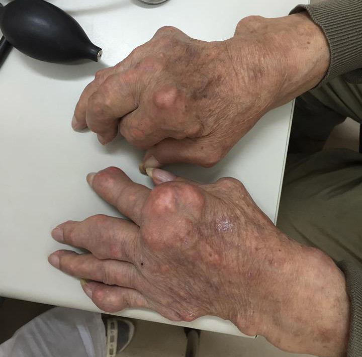 Picture 1 of Symptoms, complications of gout and medication treatment