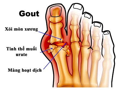 Picture 2 of Symptoms, complications of gout and medication treatment
